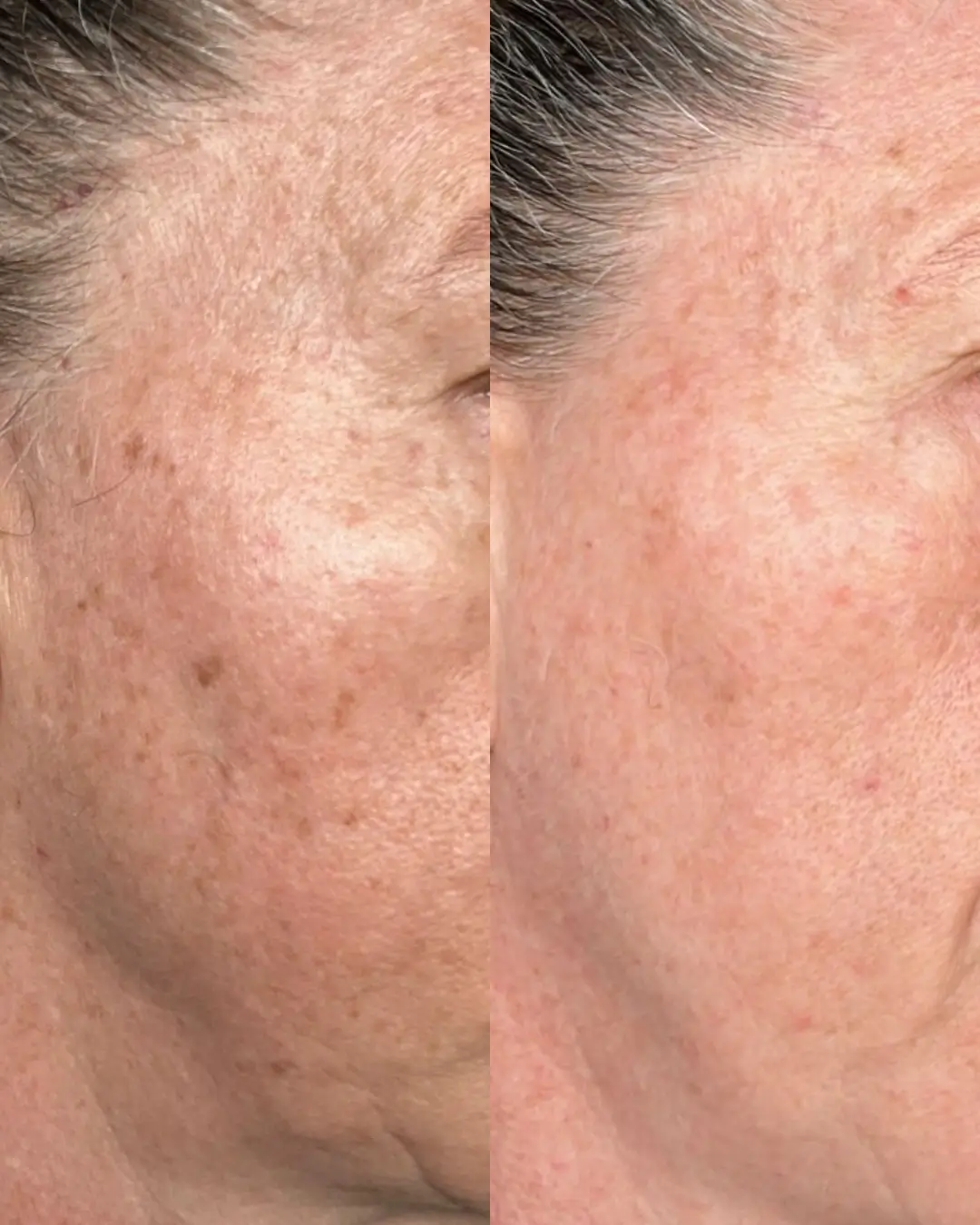 Resultado antes e depois da pele